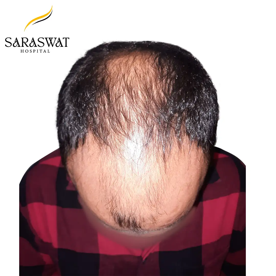 Hair Transplant Before and After Result