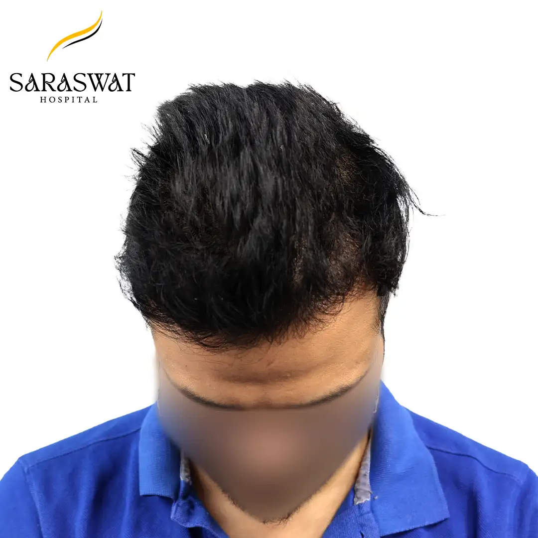Hair Transplant Before After