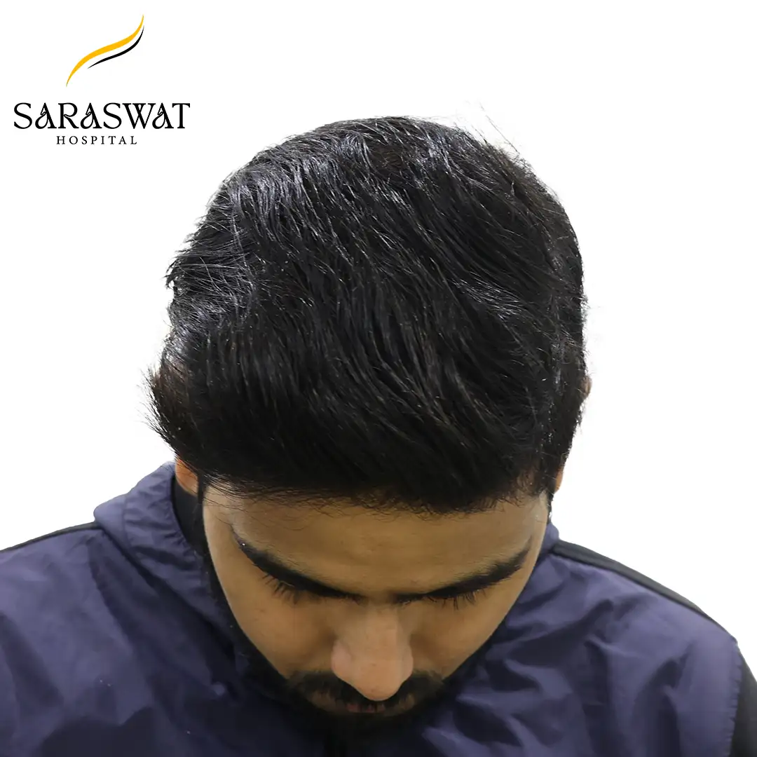 Top FUE Hair Transplant Result After Procedure