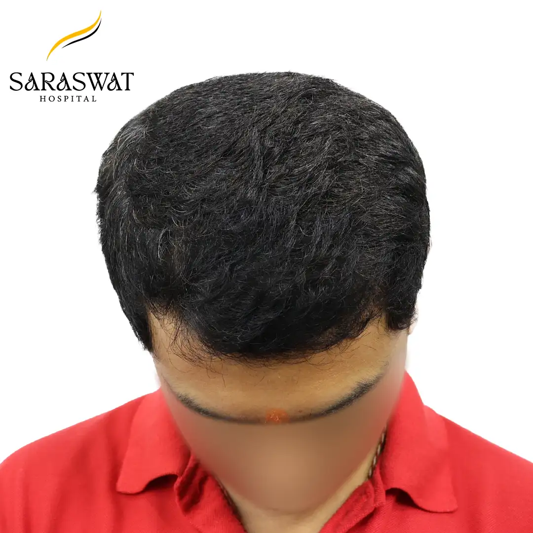 Top FUE Hair Transplant Result After Procedure
