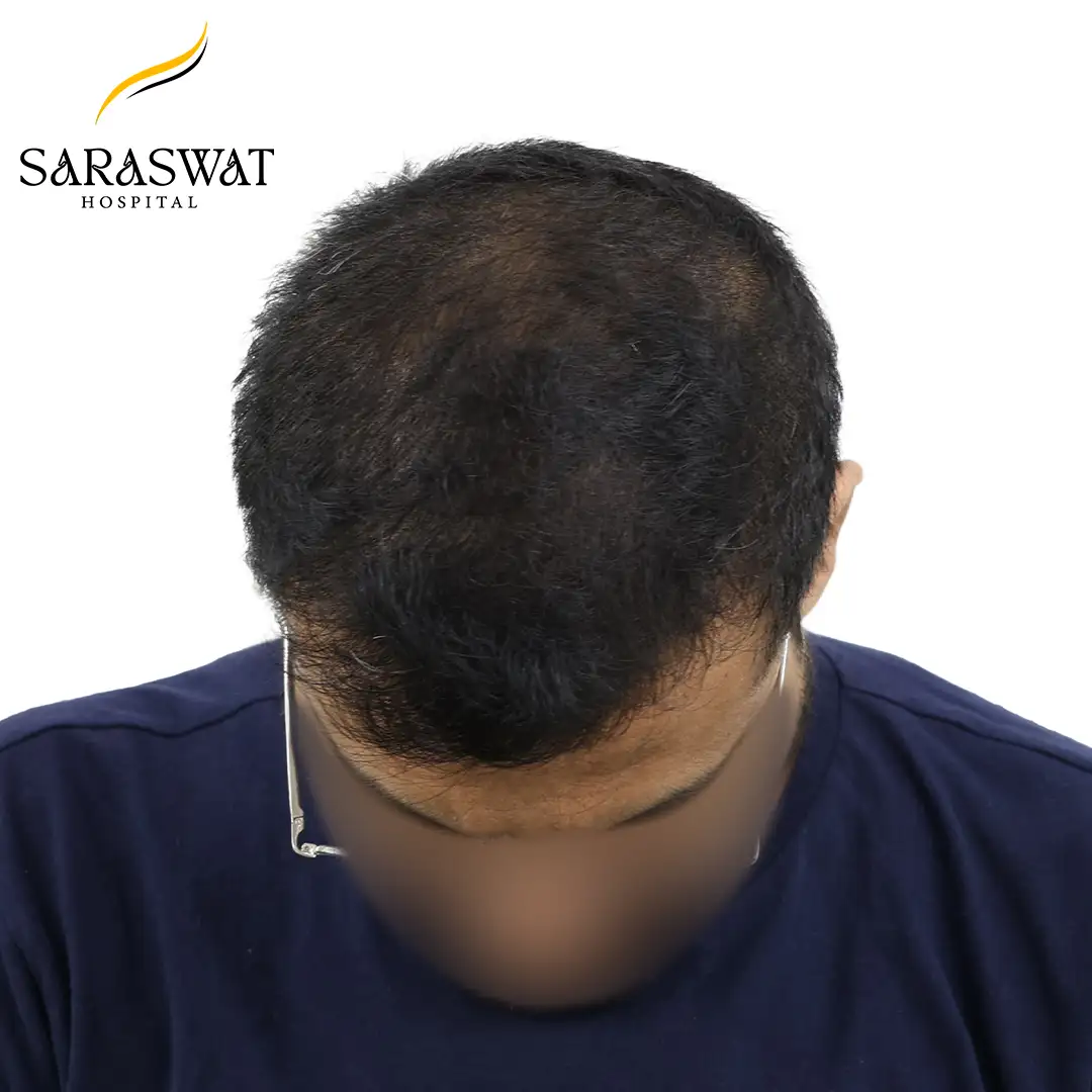 FUE Hair Transplant
