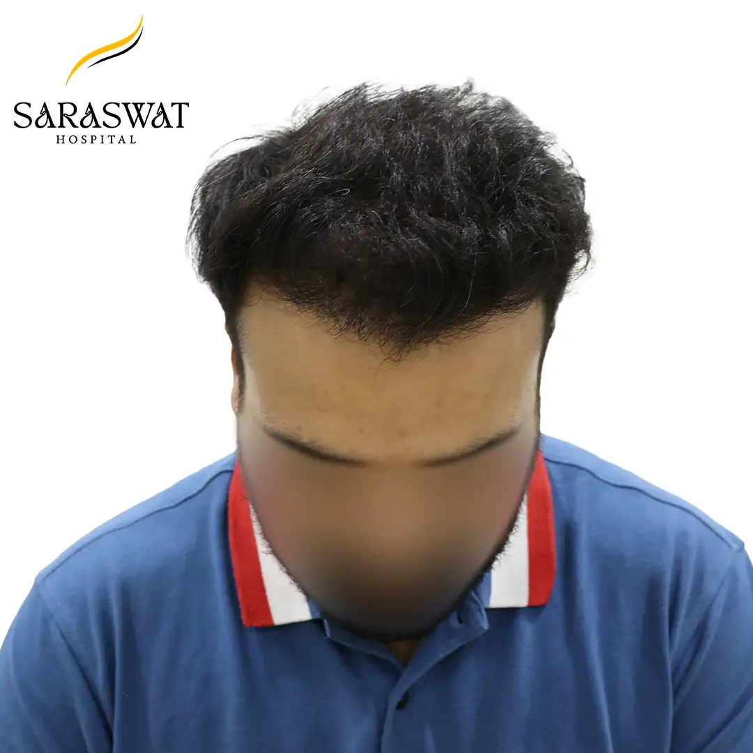 Top FUE Hair Transplant Result After Procedure