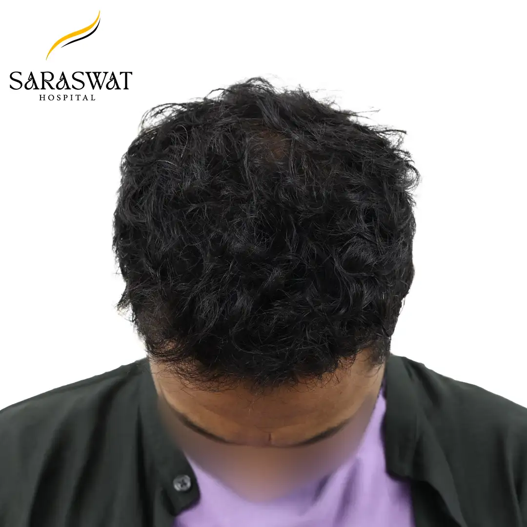 Top FUE Hair Transplant Result After Procedure