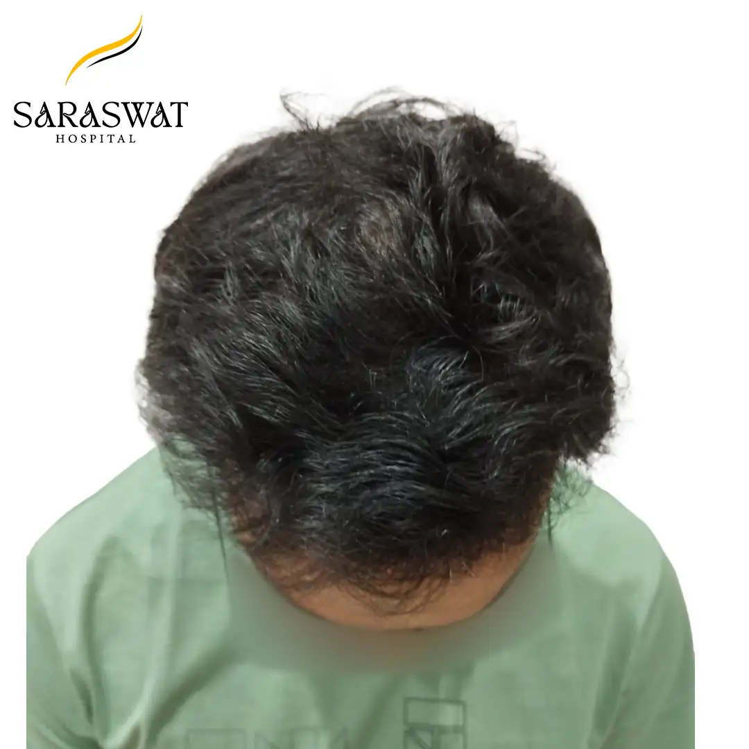 Top FUE Hair Transplant Result After Procedure