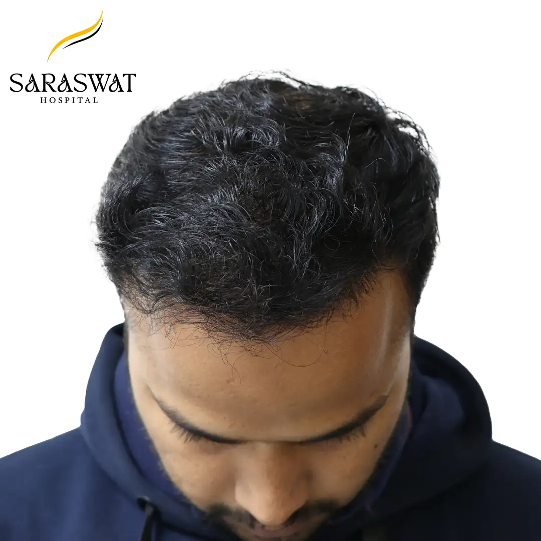 Top FUE Hair Transplant Result After Procedure