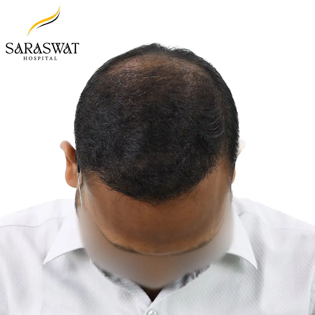 Hair Transplant Before and After Results