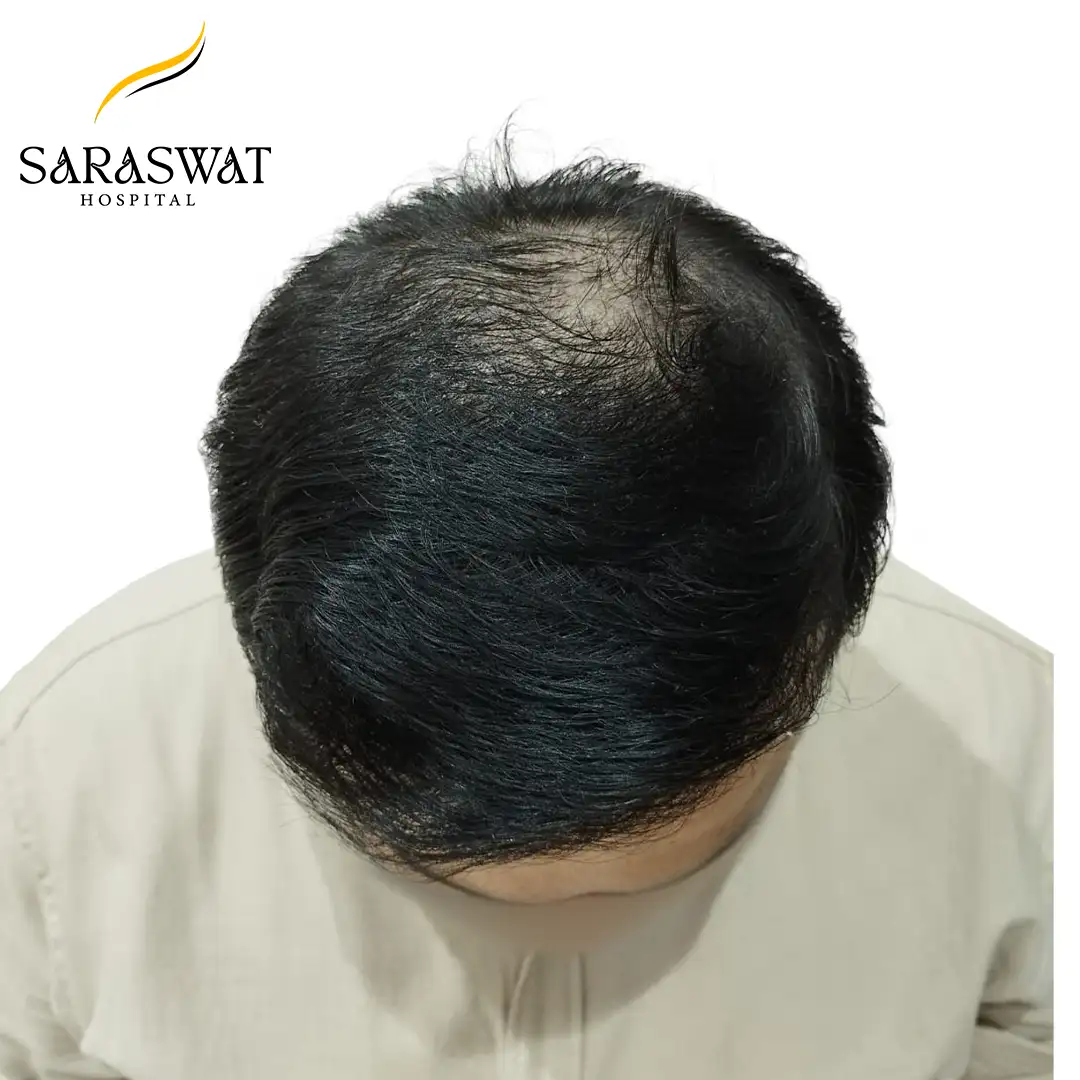 Top FUE Hair Transplant Result After Procedure
