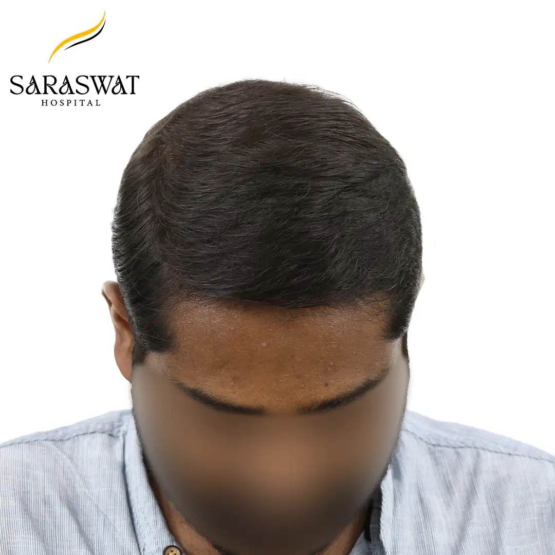 Top FUE Hair Transplant Result After Procedure