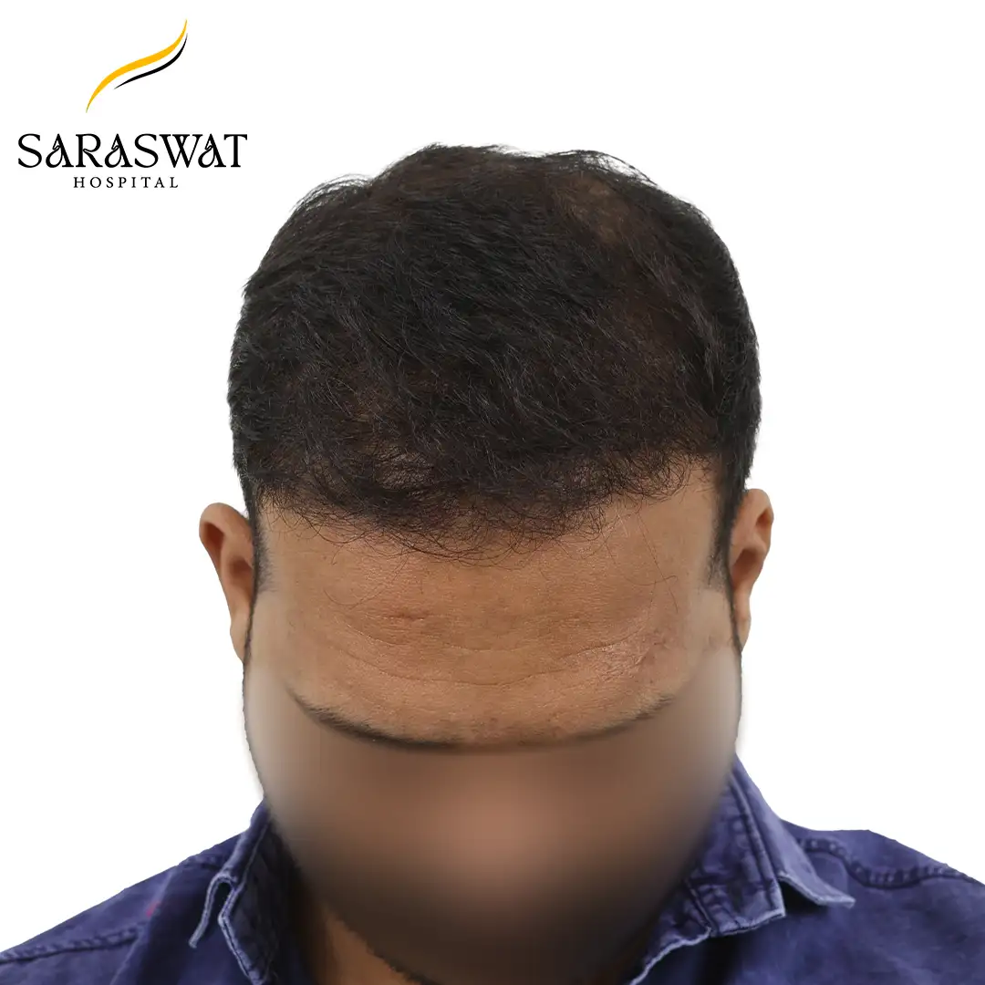 Top FUE Hair Transplant Result After Procedure
