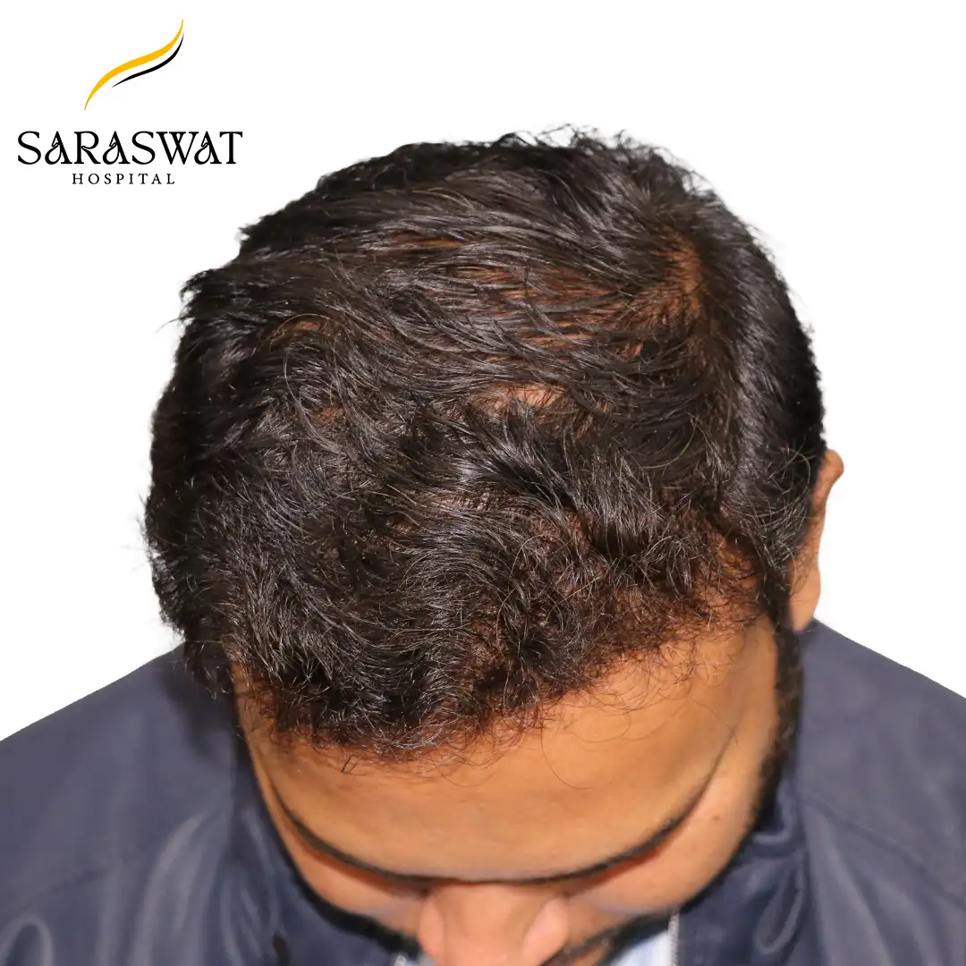 Top FUE Hair Transplant Result After Procedure