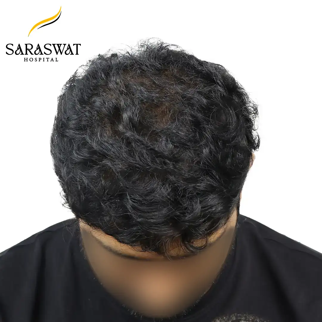 Top FUE Hair Transplant Result After Procedure