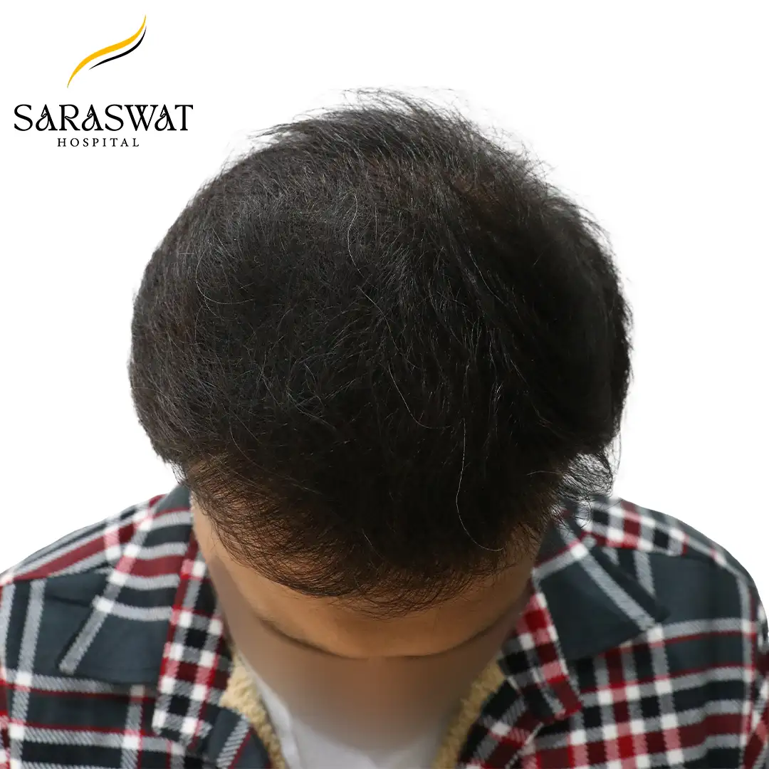 Hair Transplant Before and After