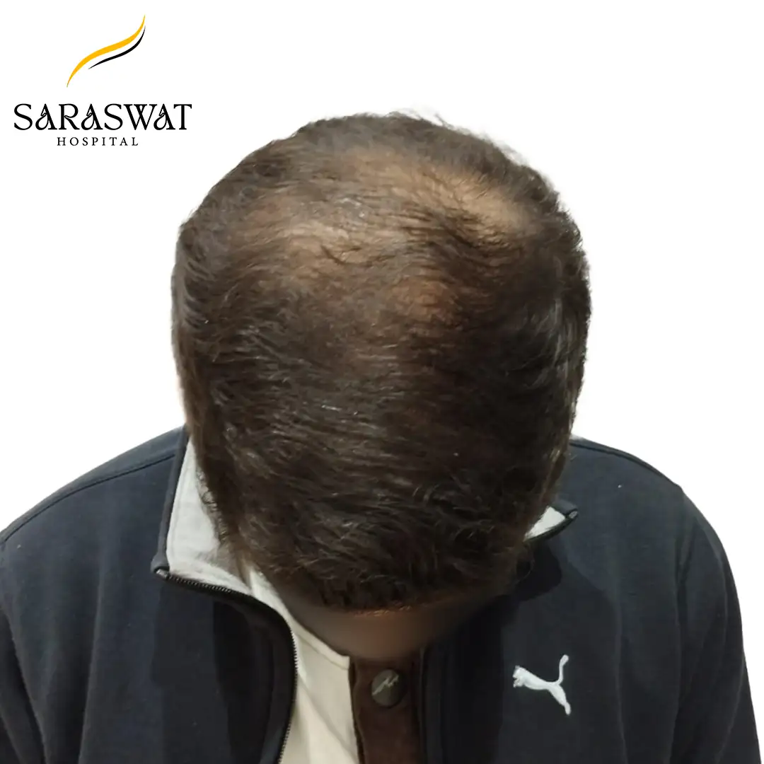 Hair Transplant Cost in India