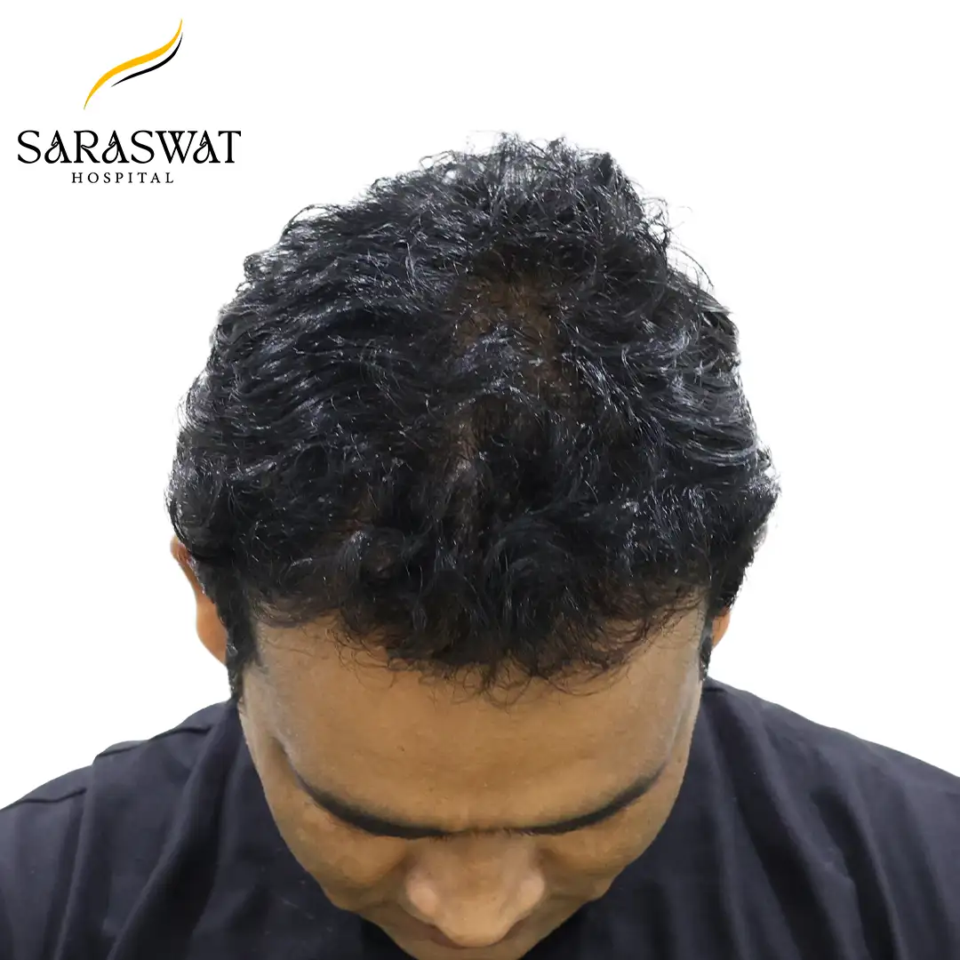 Top FUE Hair Transplant Result After Procedure