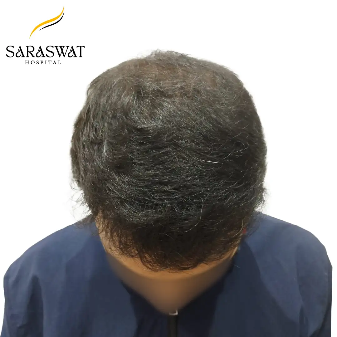 Top FUE Hair Transplant Result After Procedure