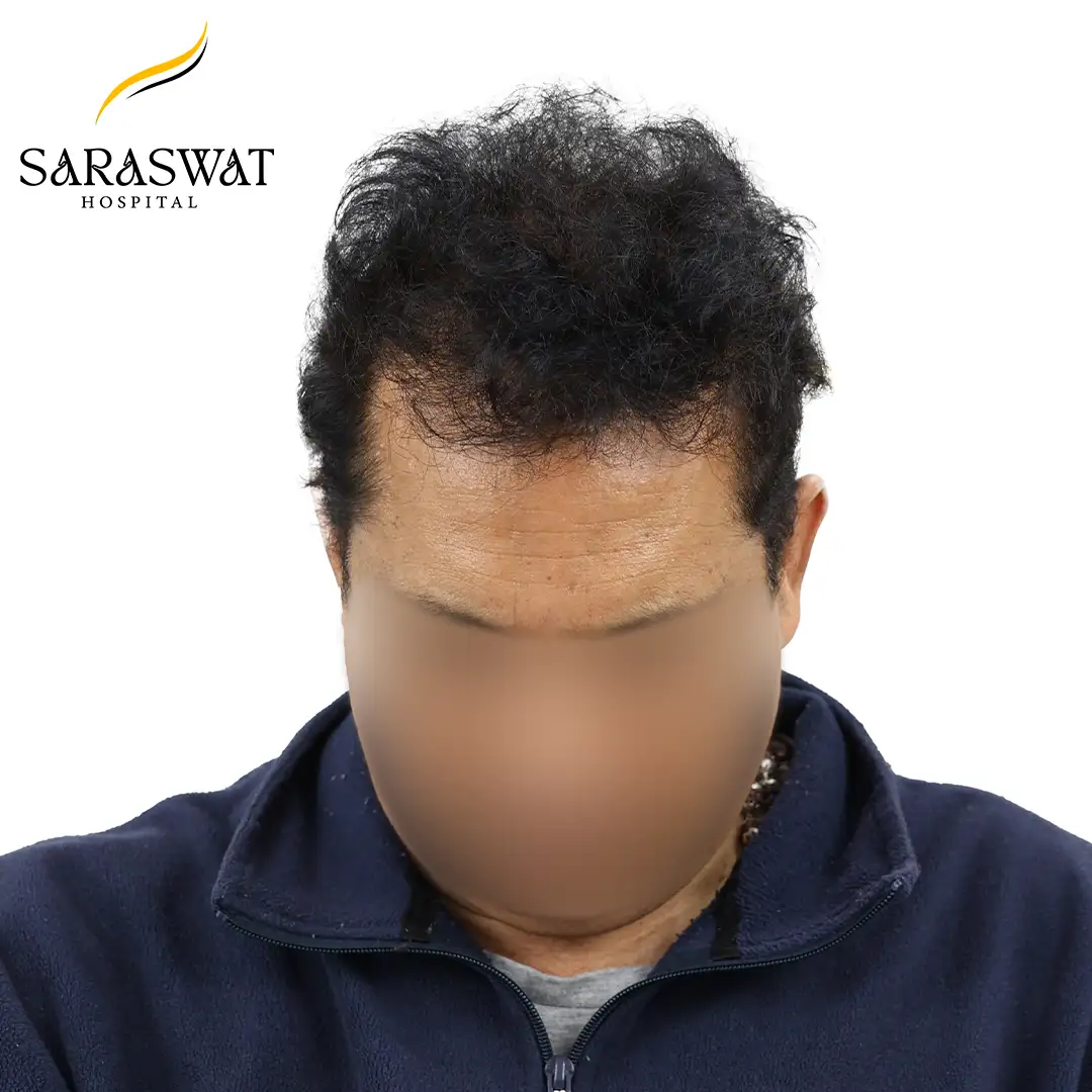 After Hair Transplant Result