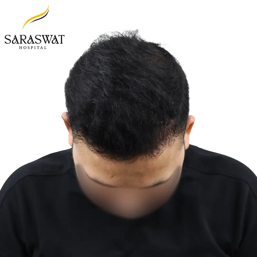 Top FUE Hair Transplant Result After Procedure