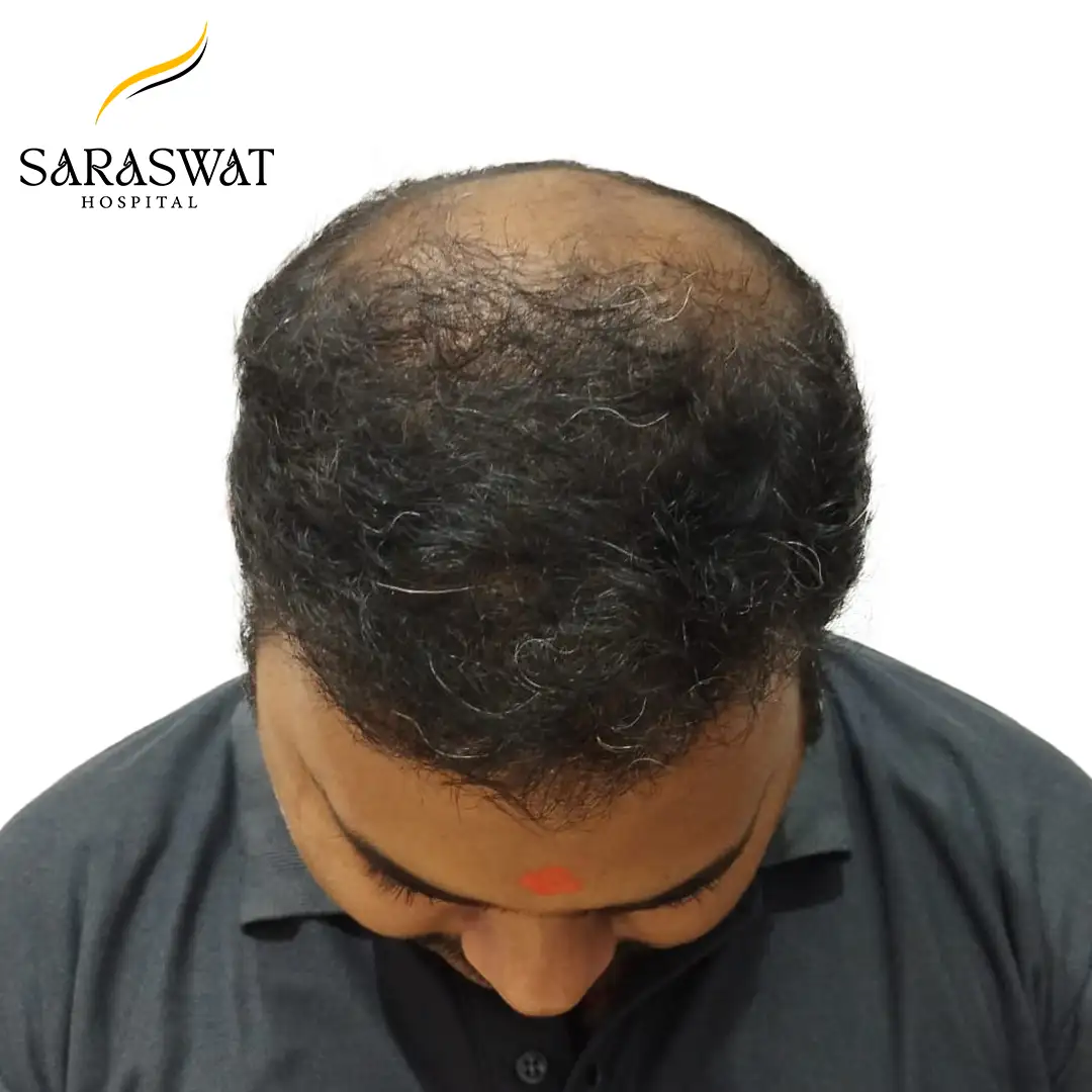Top FUE Hair Transplant Result After Procedure