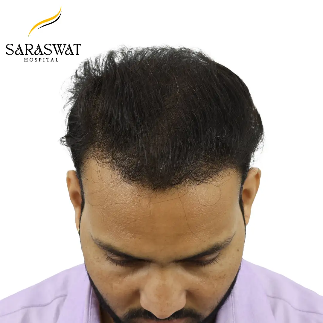 Top FUE Hair Transplant Result After Procedure