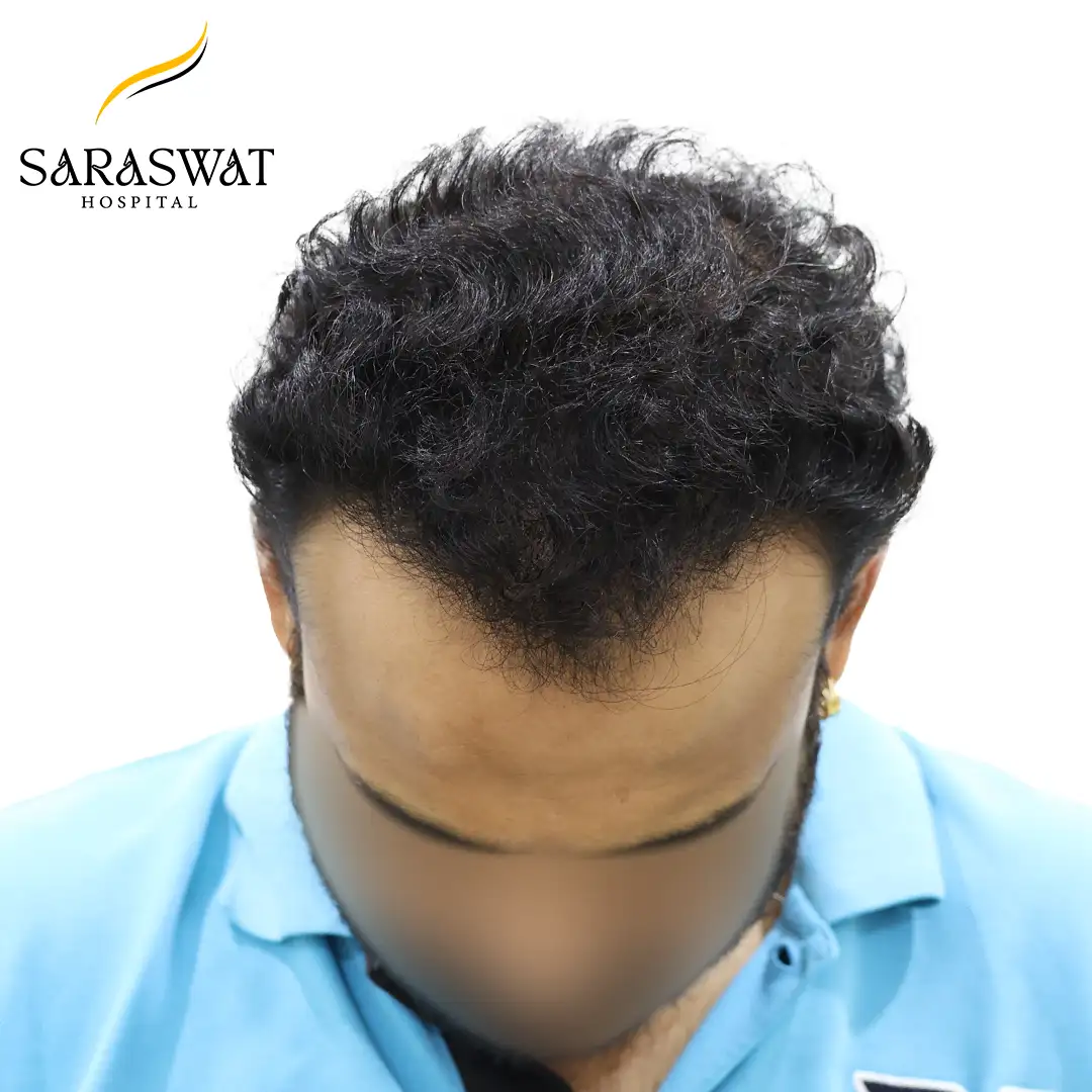 Top FUE Hair Transplant Result After Procedure