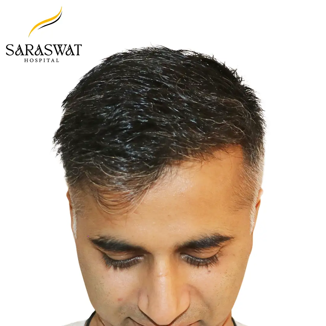 Top FUE Hair Transplant Result After Procedure
