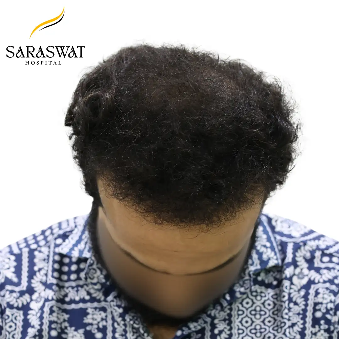 Hair Transplant Before After