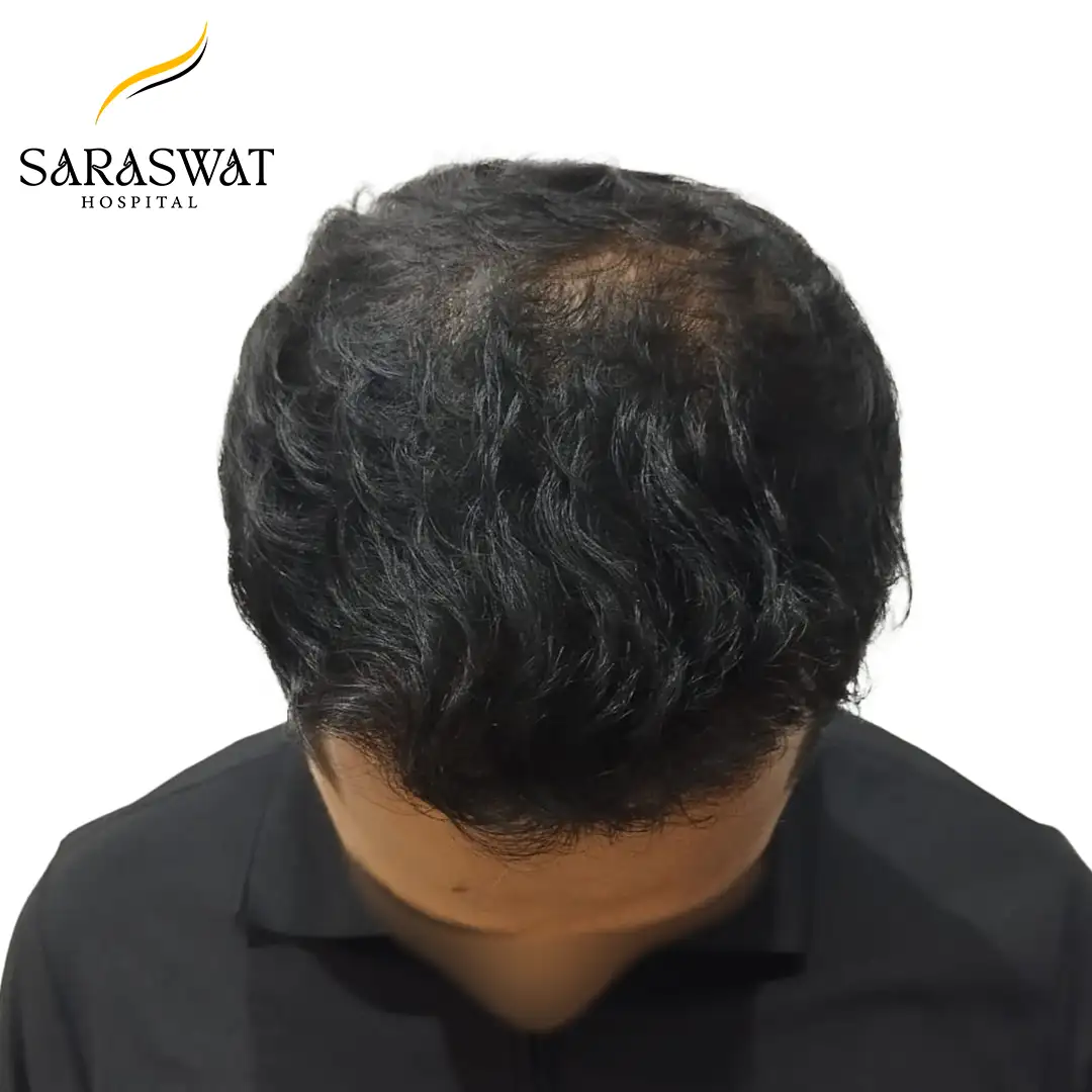 Top FUE Hair Transplant Result After Procedure