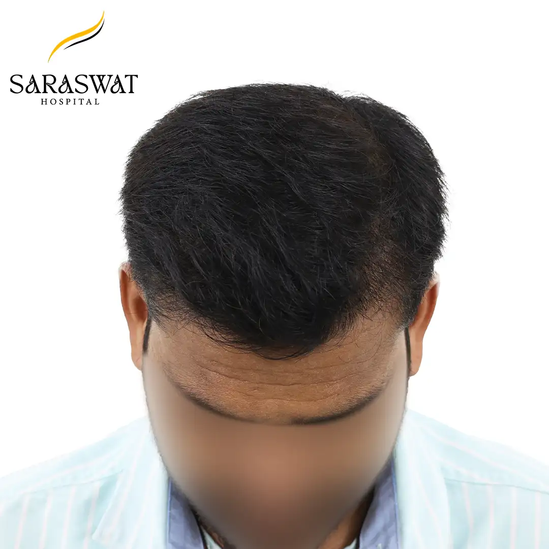 Top FUE Hair Transplant Result After Procedure