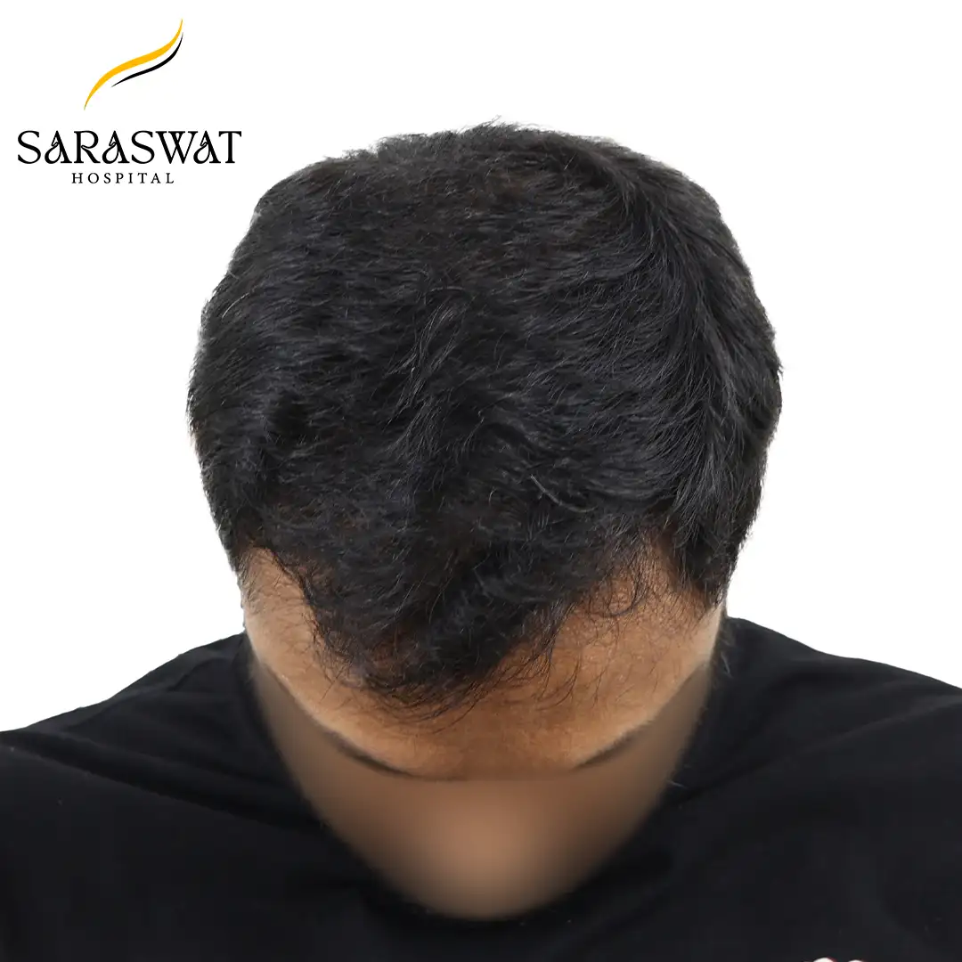 Top FUE Hair Transplant Result After Procedure