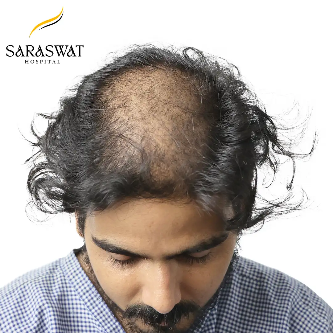 Top FUE Hair Transplant Result Before Procedure