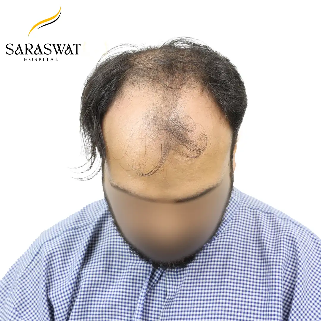Top FUE Hair Transplant Result Before Procedure