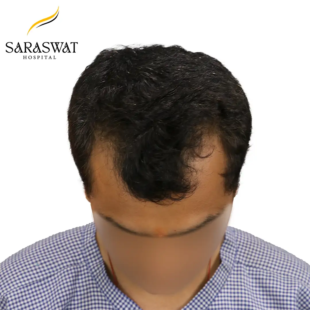 Top FUE Hair Transplant Result Before Procedure