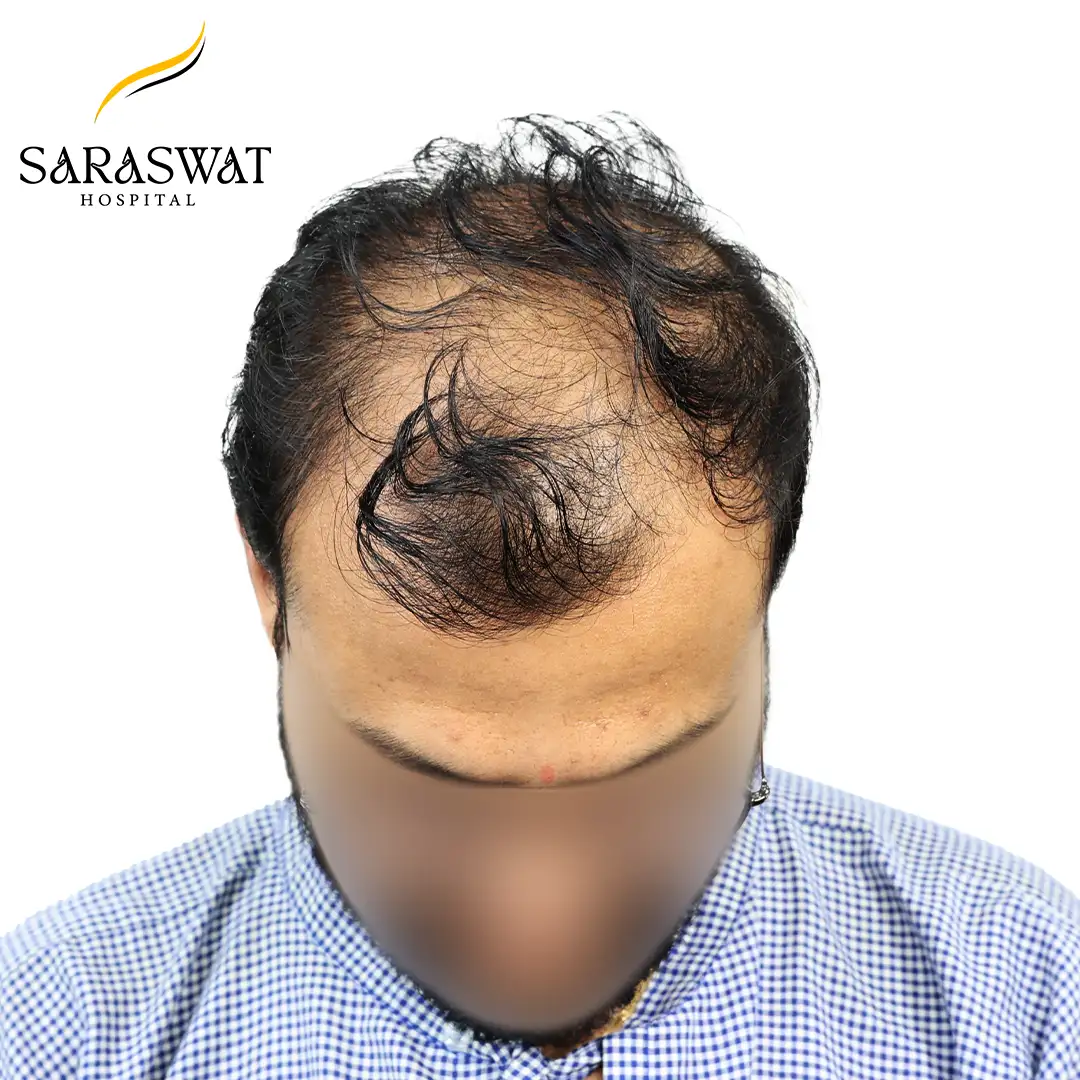 Top FUE Hair Transplant Result Before Procedure