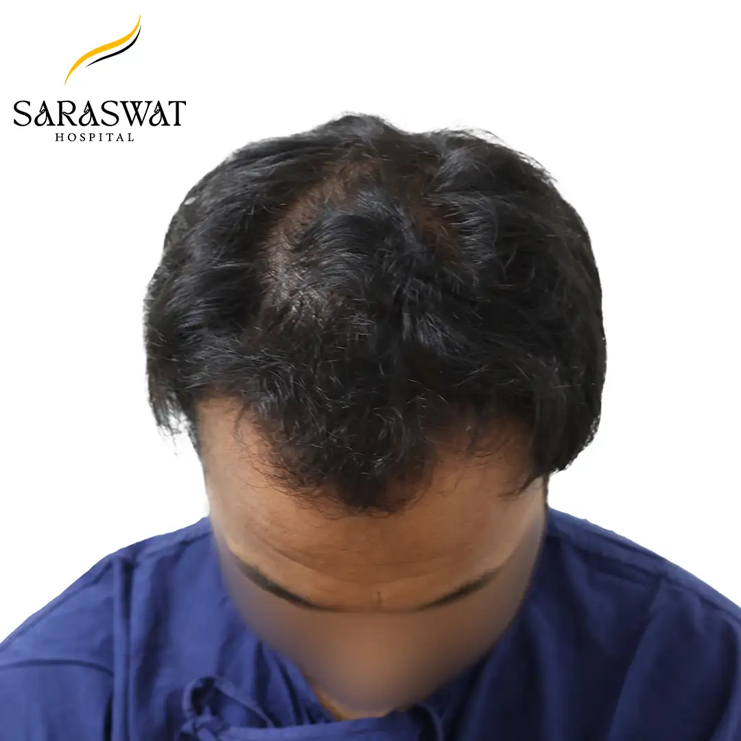 Top FUE Hair Transplant Result Before Procedure