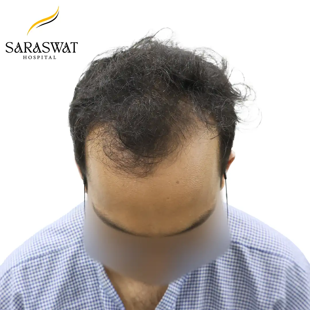 Top FUE Hair Transplant Result Before Procedure