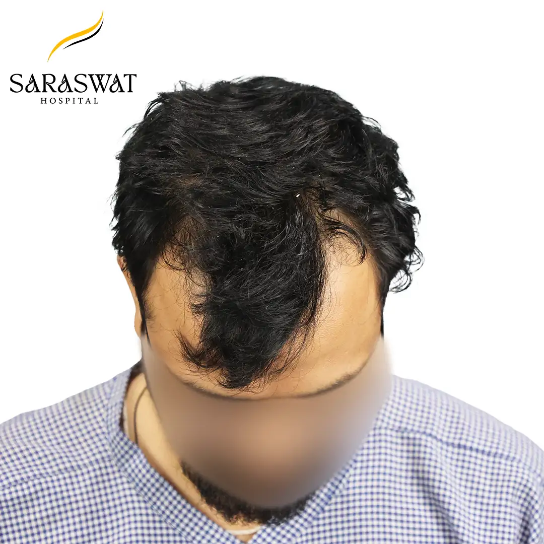 Top FUE Hair Transplant Result Before Procedure