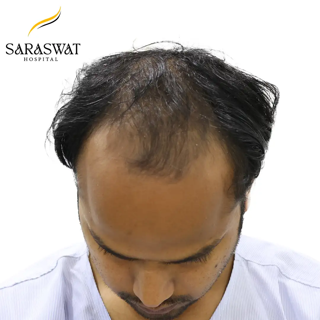Top FUE Hair Transplant Result Before Procedure