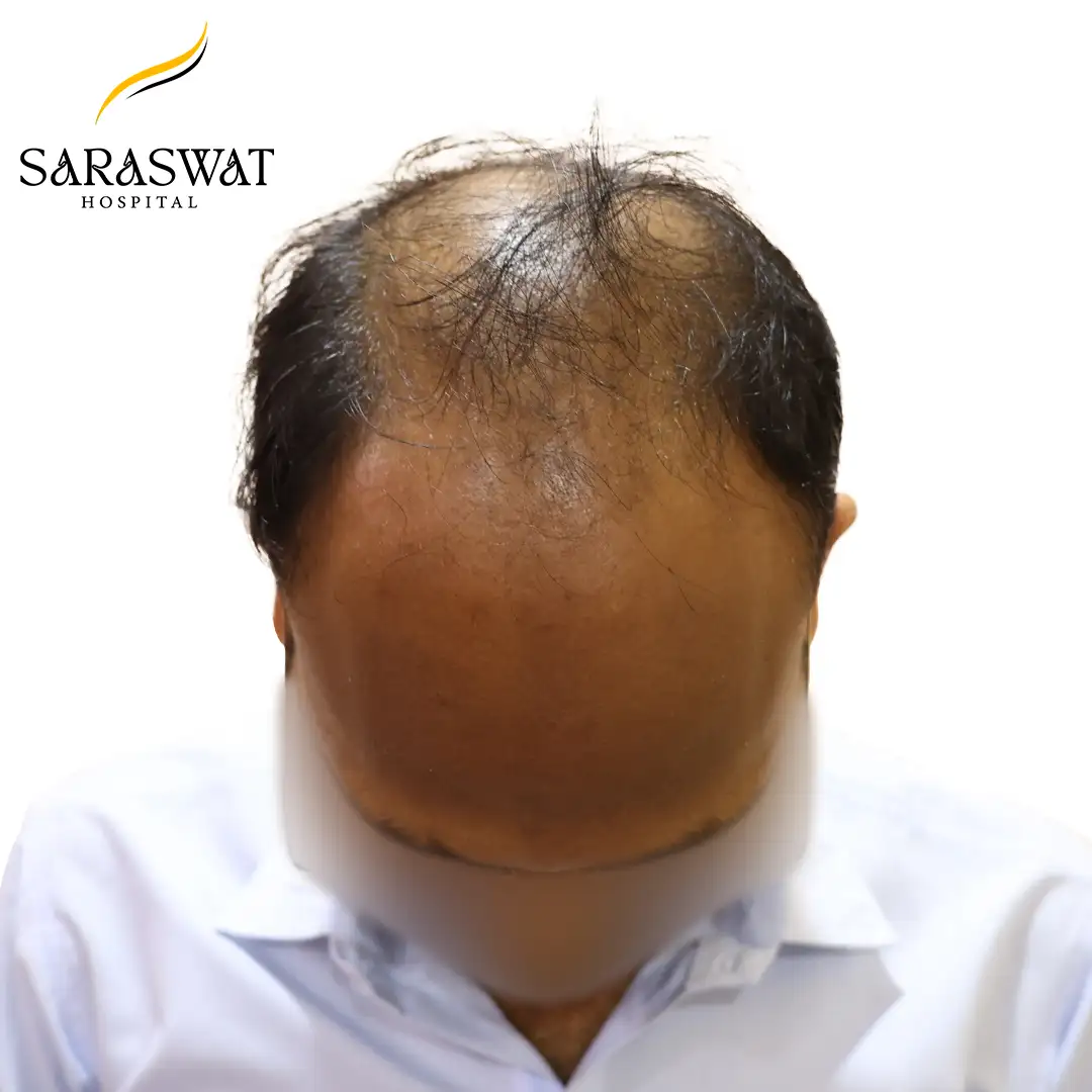 Hair Transplant Before and After Results