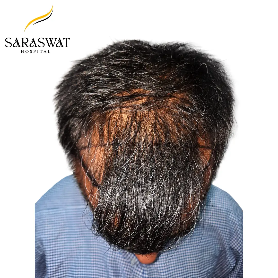 Top FUE Hair Transplant Result Before Procedure