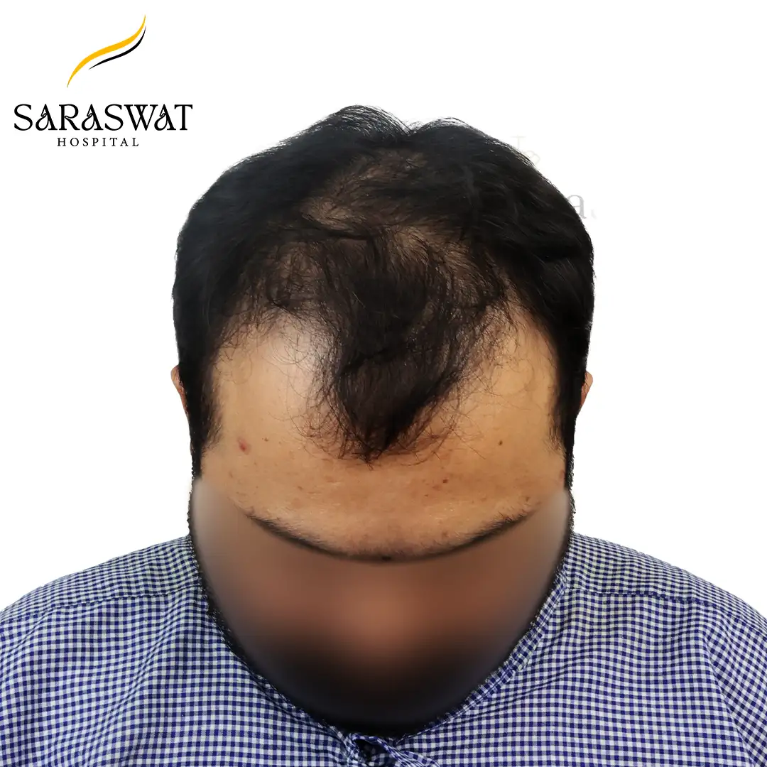 Top FUE Hair Transplant Result Before Procedure