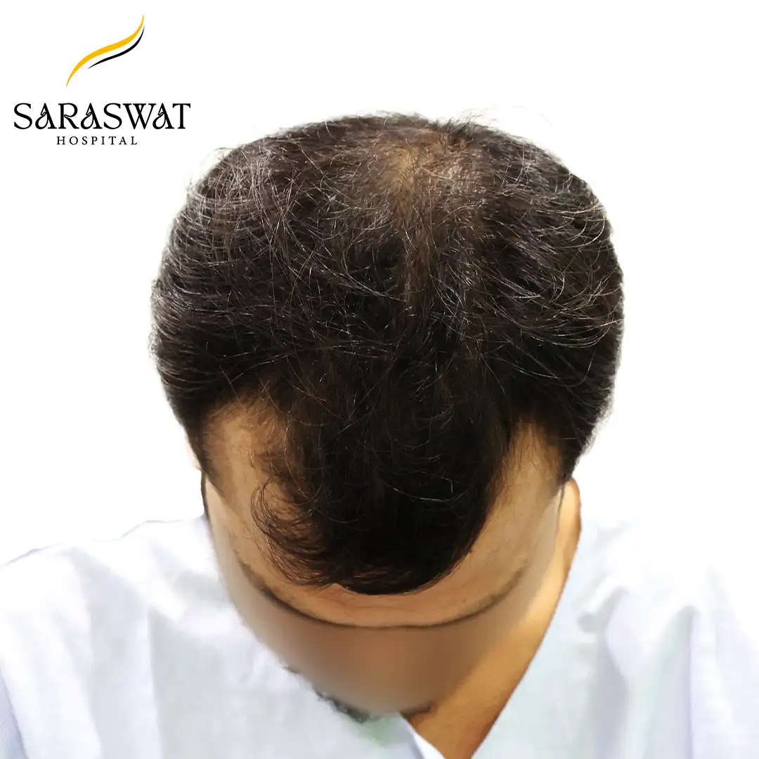 Top FUE Hair Transplant Result Before Procedure