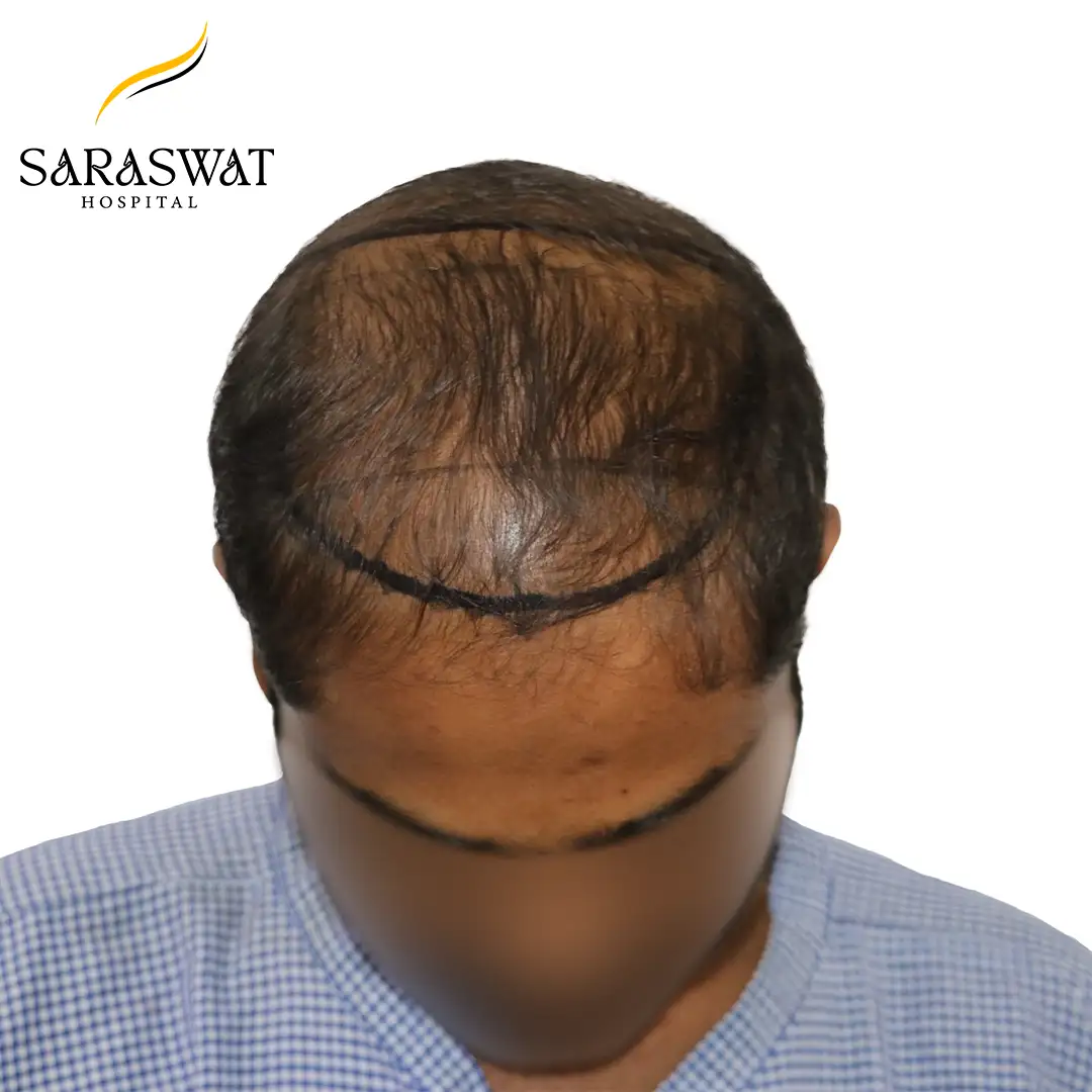 Top FUE Hair Transplant Result Before Procedure