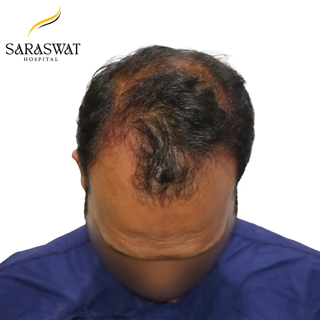 Top FUE Hair Transplant Result Before Procedure