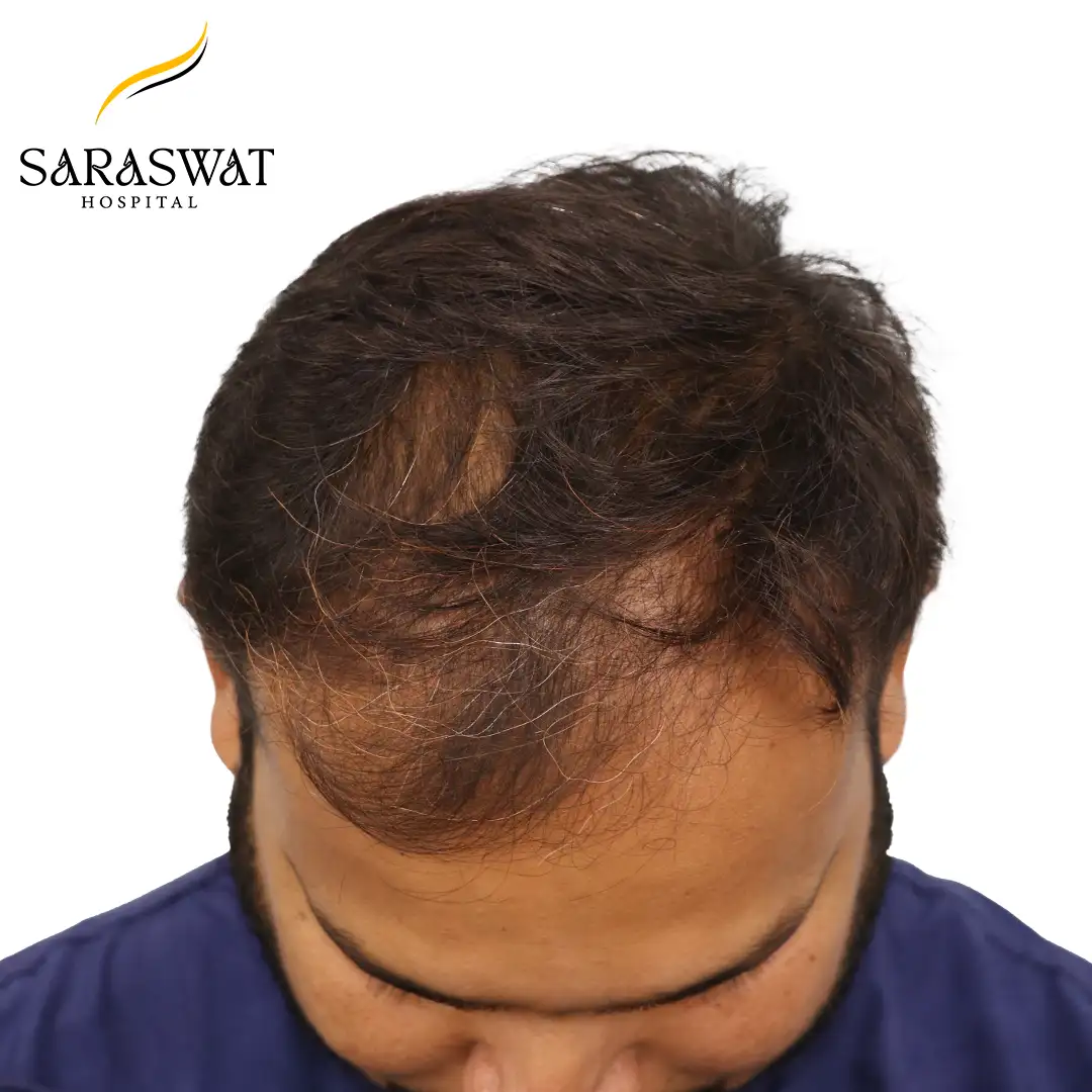 Top FUE Hair Transplant Result Before Procedure