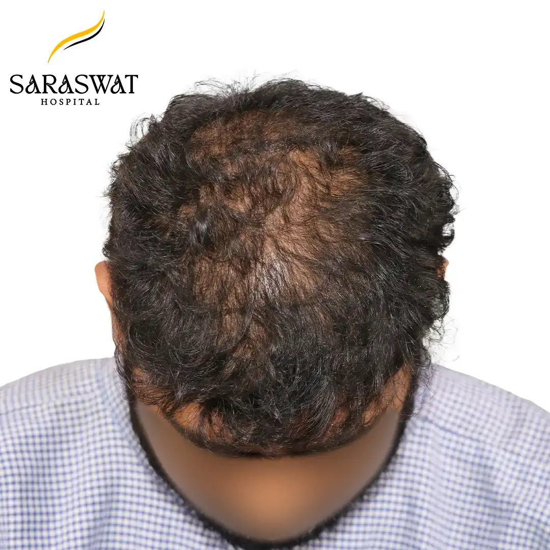 Top FUE Hair Transplant Result Before Procedure
