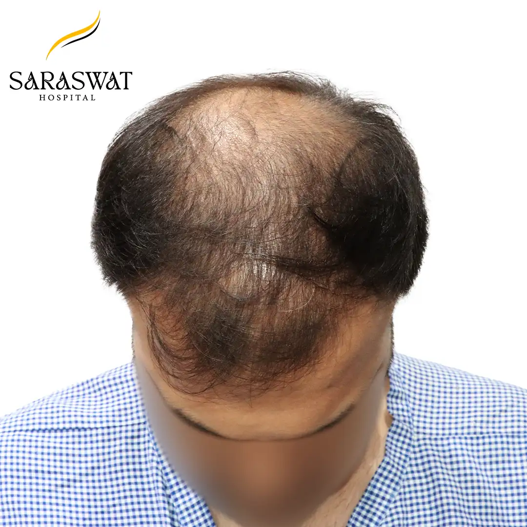 Hair Transplant Before and After