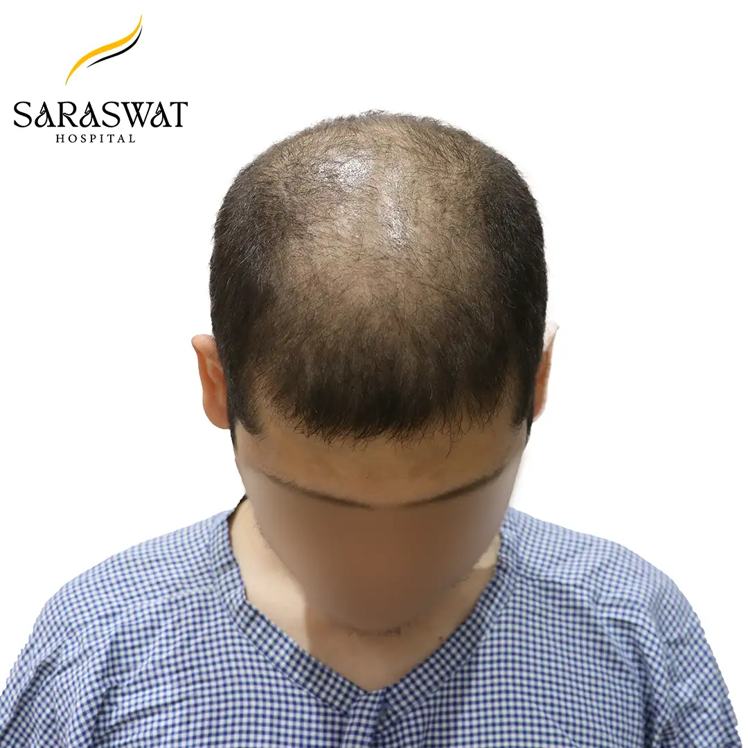 Hair Transplant Cost in India