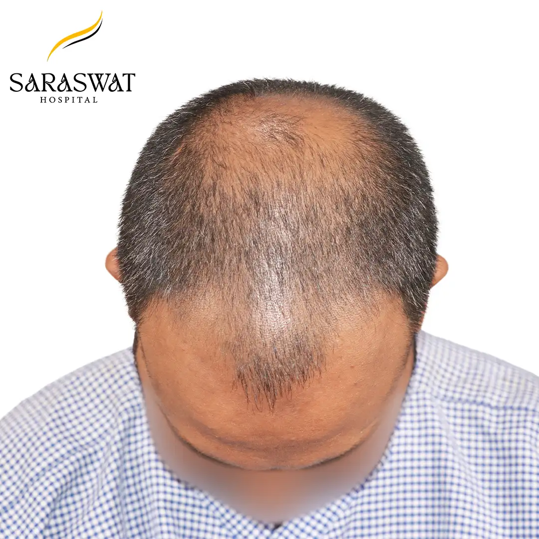 Hair Transplant Before and After Results