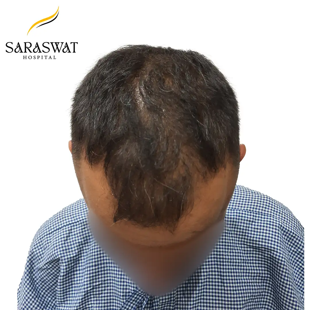 Top FUE Hair Transplant Result Before Procedure