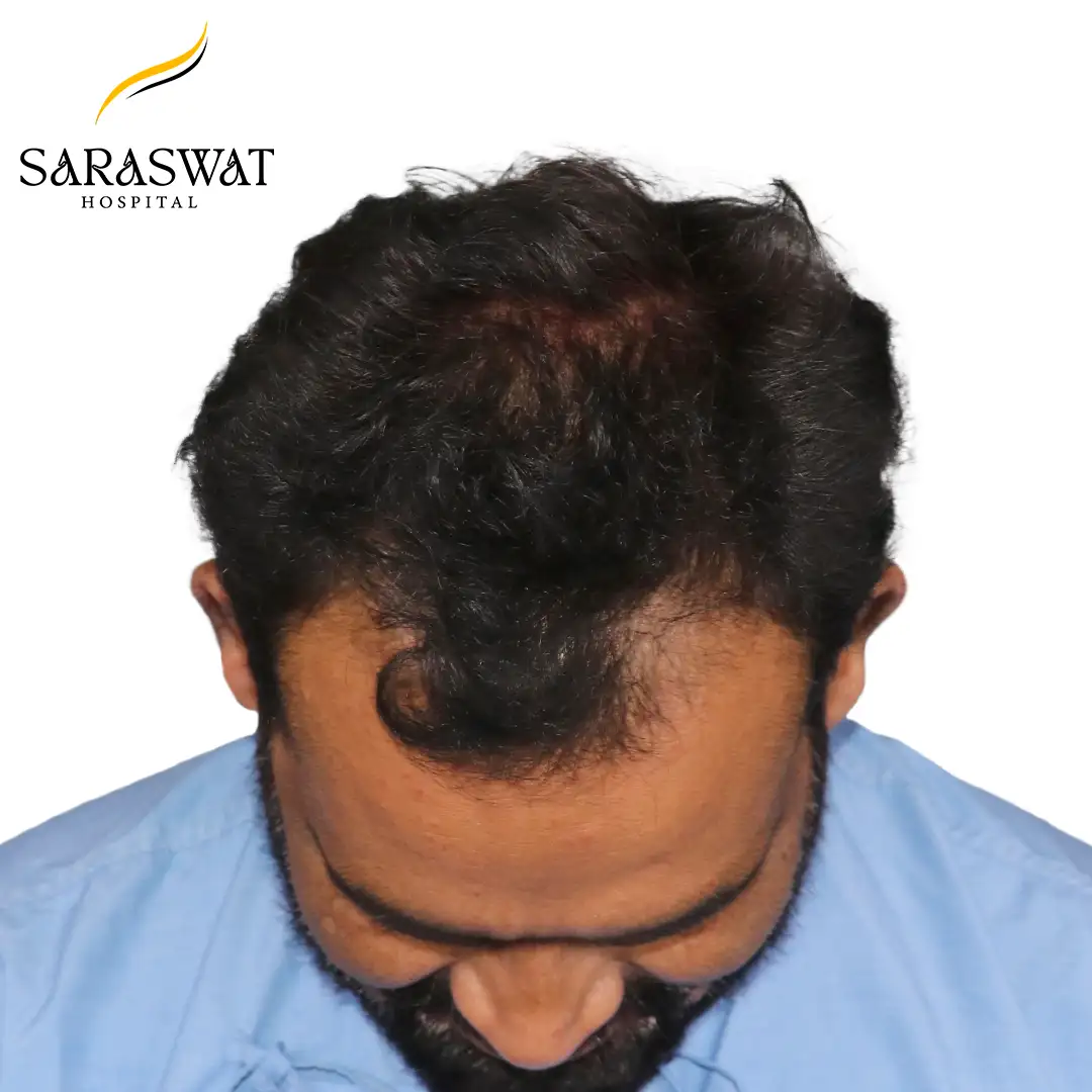 Top FUE Hair Transplant Result Before Procedure